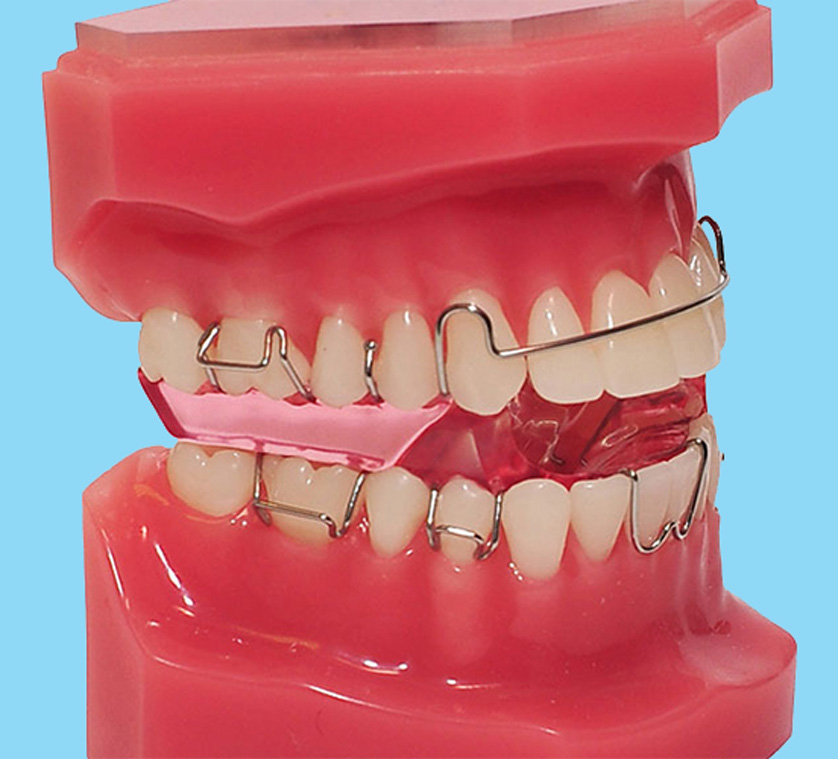 Twin block appliance | Lingual Braces Provider Glasgow | Infinity Smiles