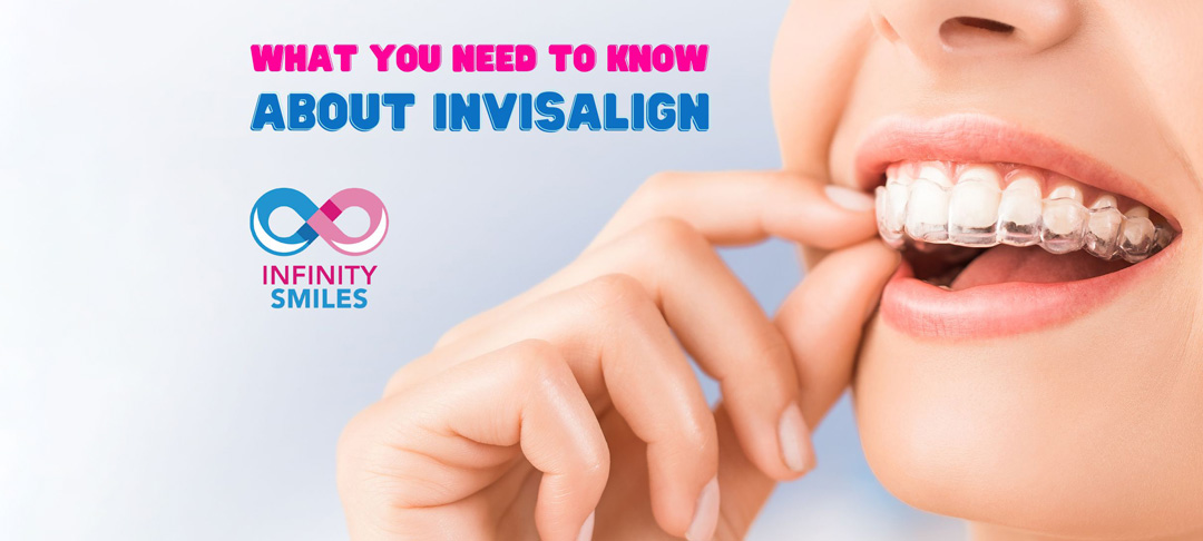 What You Need to Know About Invisalign: Clear Aligners for Straightening Teeth Introduction